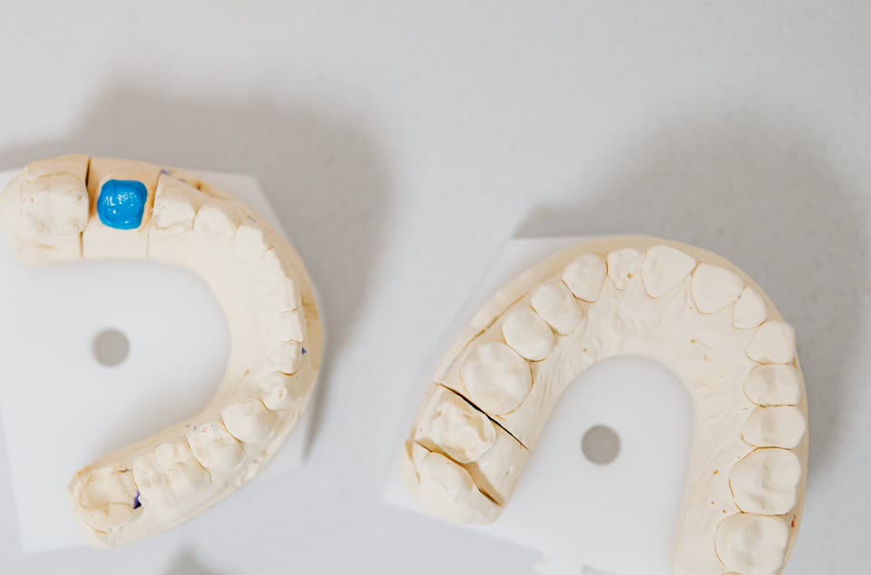 Stone models poured from impressions