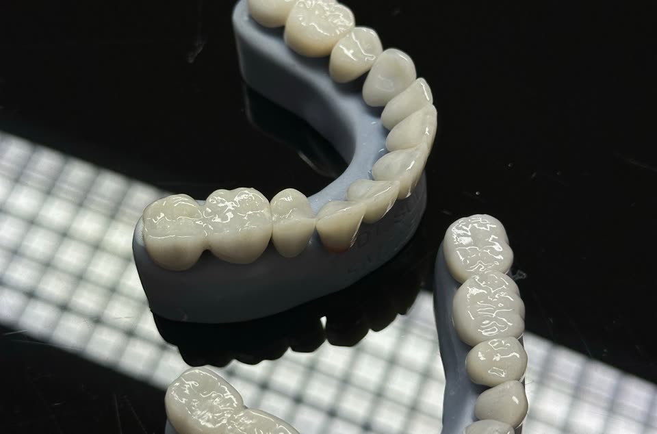 A printed model and milled crowns