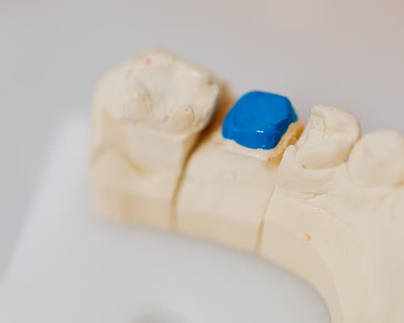A stone model with a single prepared tooth
