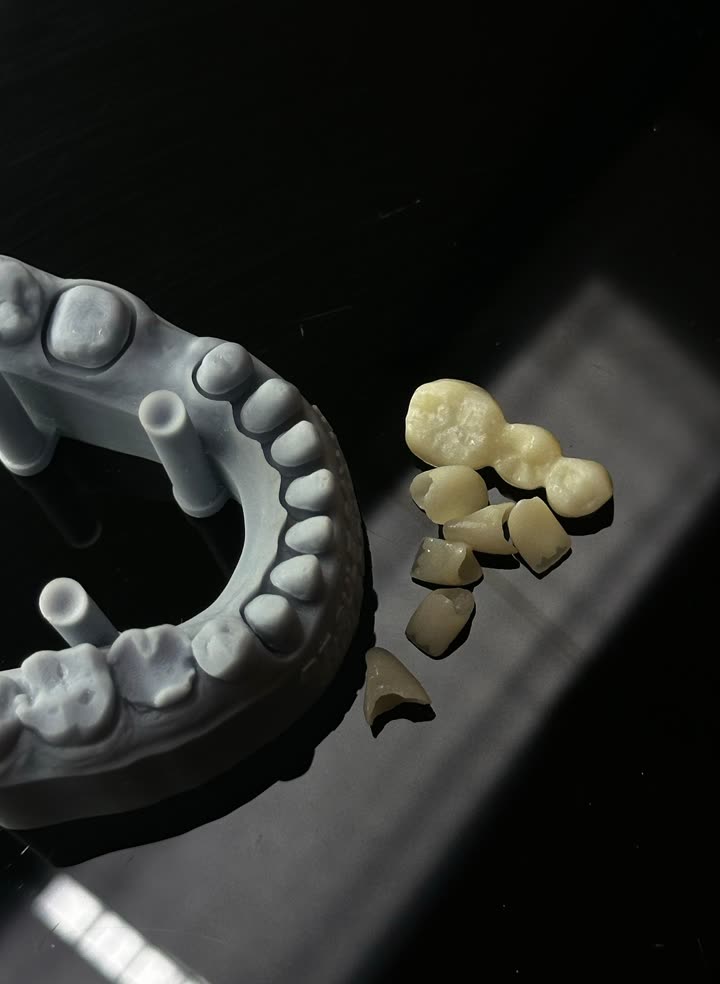 Implant crowns beside a printed model